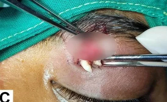 16 Yaşındaki Çocuğun Göz Çukurunda Ektopik Diş Tespit Edildi - www.gundemedair.com