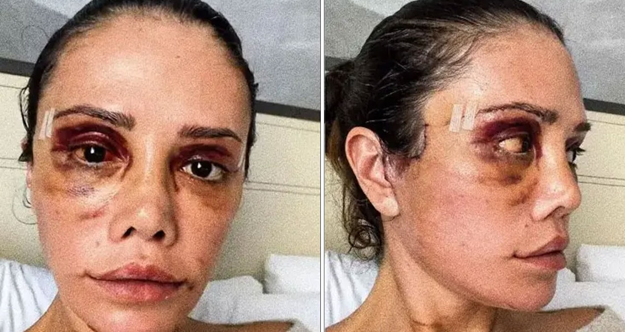 Didem Ceran’ın yüzüne yeni estetik uygulamalar yaptıracağını açıklamasıyla ilgili haber görseli