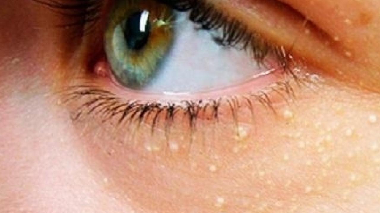 Göz çevresindeki lekeler kalp krizi ve inme riskini artırıyor